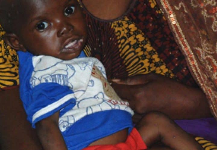 Enfant malien souffrant de malnutrition